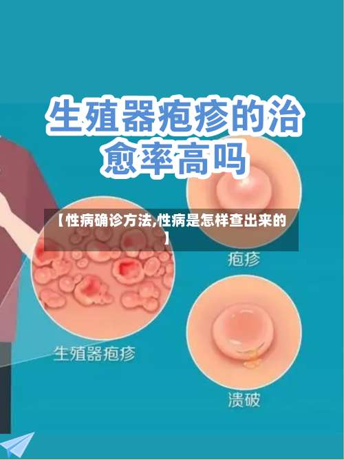 【性病确诊方法,性病是怎样查出来的】-第2张图片