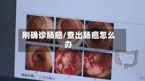 刚确诊肠癌/查出肠癌怎么办