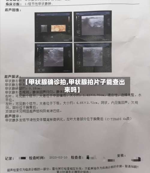 【甲状腺确诊拍,甲状腺拍片子能查出来吗】-第2张图片