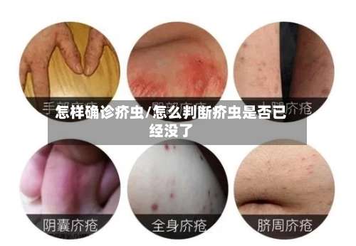怎样确诊疥虫/怎么判断疥虫是否已经没了