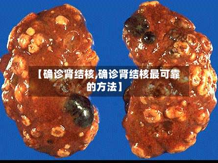 【确诊肾结核,确诊肾结核最可靠的方法】