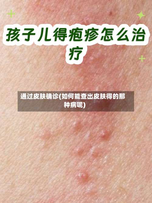 通过皮肤确诊(如何能查出皮肤得的那种病呢)-第2张图片