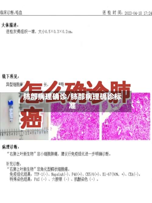 肺部病理确诊/肺部病理确诊标准-第3张图片