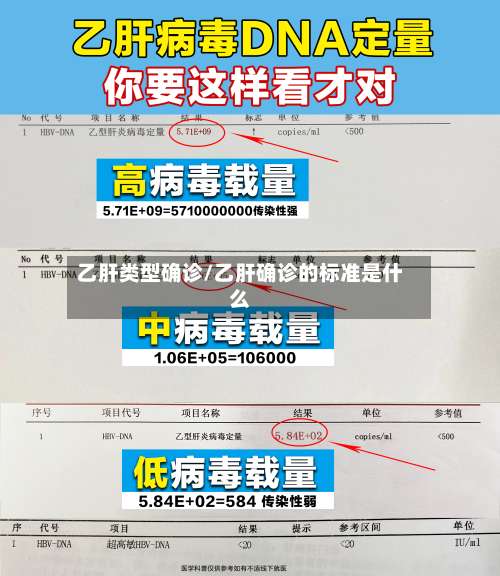 乙肝类型确诊/乙肝确诊的标准是什么-第2张图片